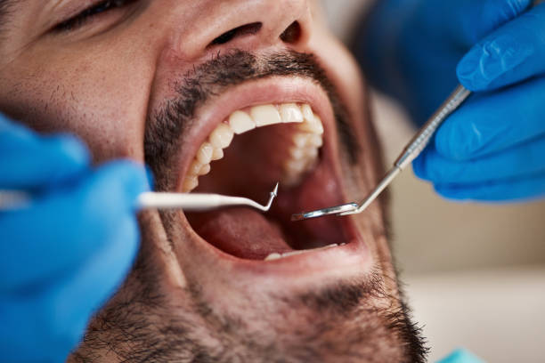 Best Dental Abscess Treatment in Canton, GA
